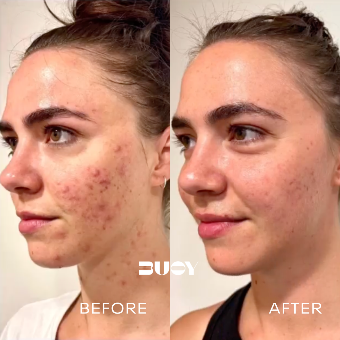 Treat Acne and Acne Scarring (the right way)
