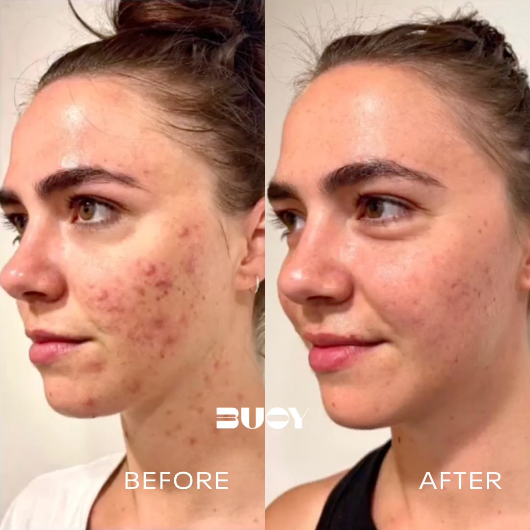 Acne Recovery Clear your acne & erase acne scars with a facial treatment plan – Buoy ...